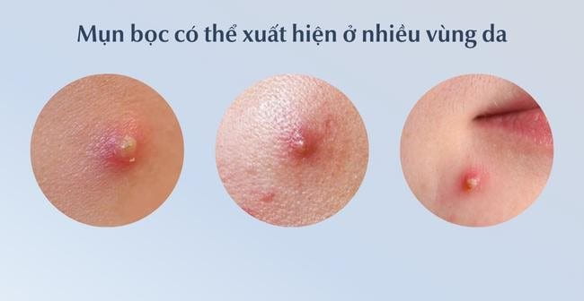 Mụn mủ là gì?