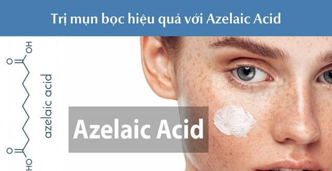 Mụn bọc bao lâu thì chín? Trị mụn bọc hiệu quả với Azelaic Acid