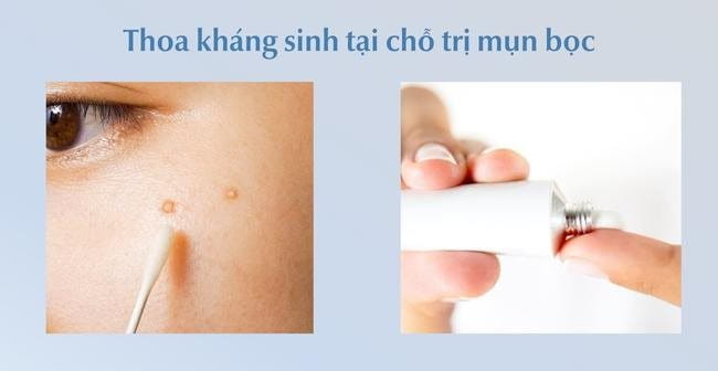 Mụn bọc bao lâu thì chín? Thoa kháng sinh tại chỗ trị mụn bọc