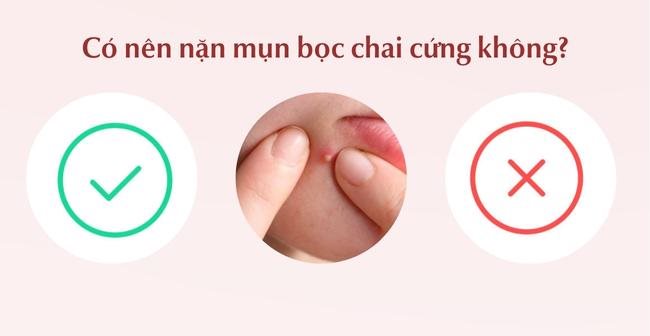 Có nên nặn mụn bọc chai cứng