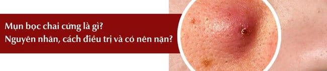Mụn bọc chai cứng là gì nguyên nhân cách điều trị có nên nặn không