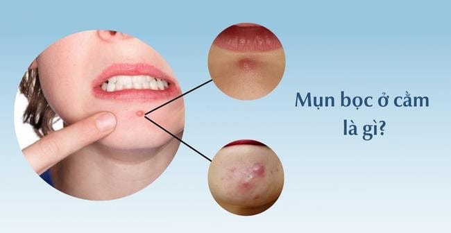 Mụn bọc ở cằm là mụn như thế nào?