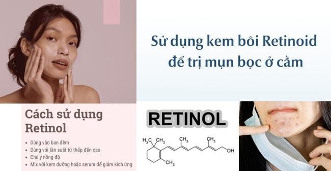 Dùng Retinoid trị mụn bọc ở cằm