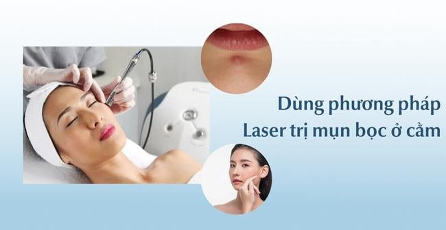 Trị mụn bọc ở cằm bằng phương pháp laser