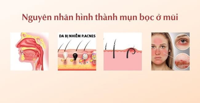 Các nguyên nhân gây nên mụn bọc ở mũi