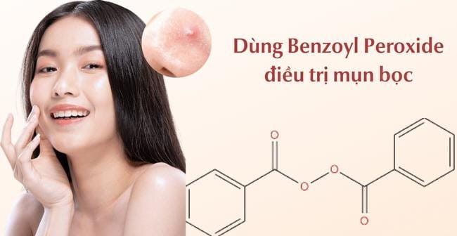 Dùng Benzoyl Peroxide trị mụn bọc ở mũi