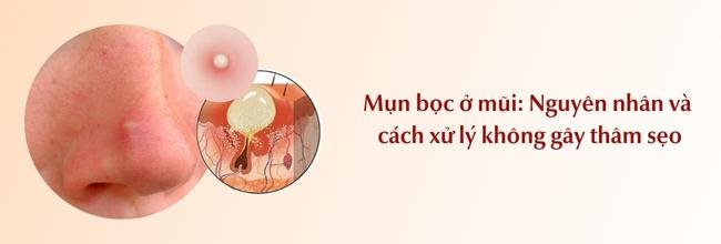 Mụn bọc ở mũi, nguyên nhân và cách xử lý an toàn