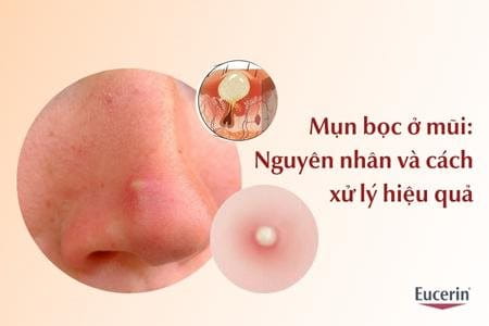 Những nguyên nhân gây ra mụn viêm ở mũi là gì?
