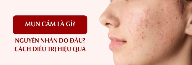 Mụn cám là gì?