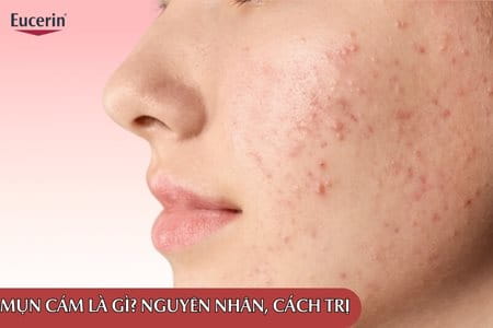 Mụn Cám Là Gì? Nguyên Nhân, Vị Trí Ưa Mọc Và Cách Điều Trị