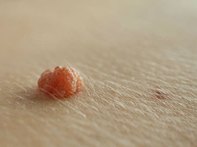 mụn cóc