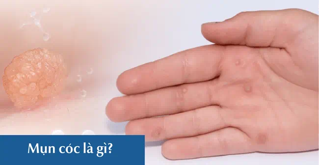 Mụn cóc là gì?