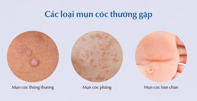 Các loại mụn cóc thường gặp