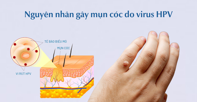 Nguyên nhân gây mụn cóc