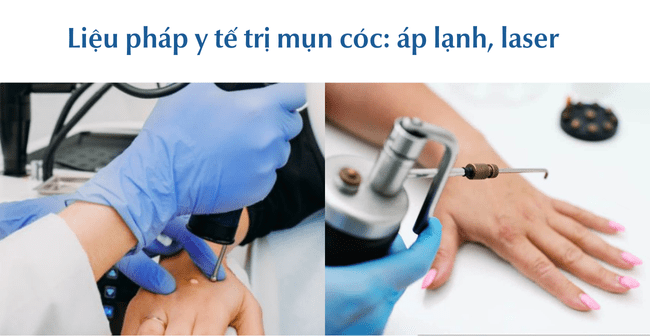 Liệu pháp y tế trị mụn cóc