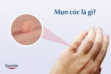 Mụn cóc là gì?
