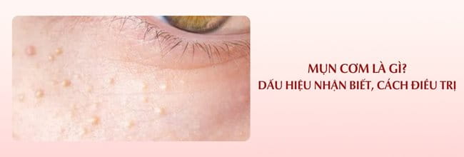 mụn cơm