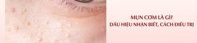 mụn cơm