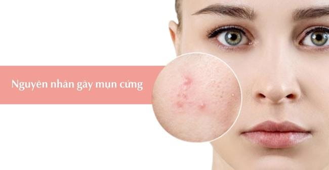 Nguyên nhân gây mụn cứng dưới da