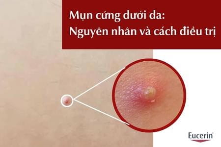 Mụn cứng dưới da là gì, nguyên nhân, cách điều trị
