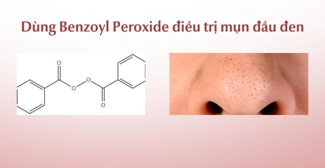 Benzoyl Peroxide trị mụn đầu đen