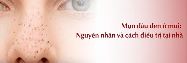 Nguyên nhân và cách điều trị mụn đầu đen ở mũi tại nhà