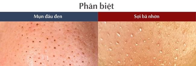Mụn đầu đen và sợi bã nhờn: Cách phân biệt và xử lý