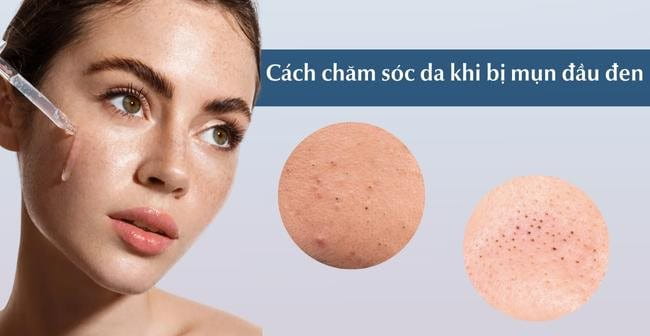 Chăm sóc da bị mụn đầu đen