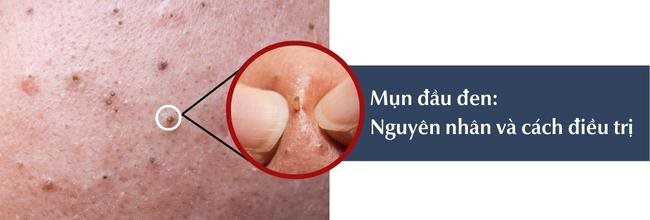 Nguyên nhân của mụn đầu đen cách điều trị hiệu quả