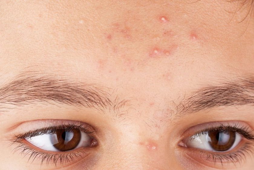 Mụn đầu trắng là gì? Nguyên nhân và cách điều trị mụn đầu trắng hiệu quả?