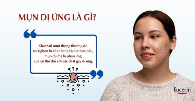 Mụn dị ứng là gì?