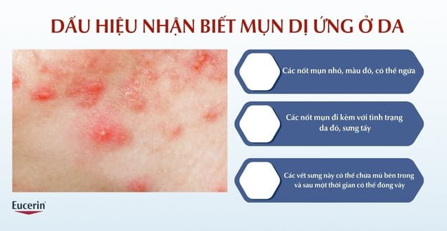 Dấu hiệu nhận biết mụn dị ứng ở da