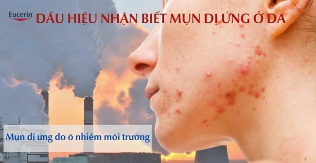 Nổi mụn kích ứng do dị ứng với thay đổi môi trường