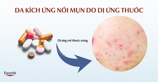 Mụn dị ứng do kích ứng với thuốc uống