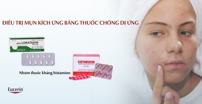 Điều trị mụn kích ứng bằng thuốc chống dị ứng