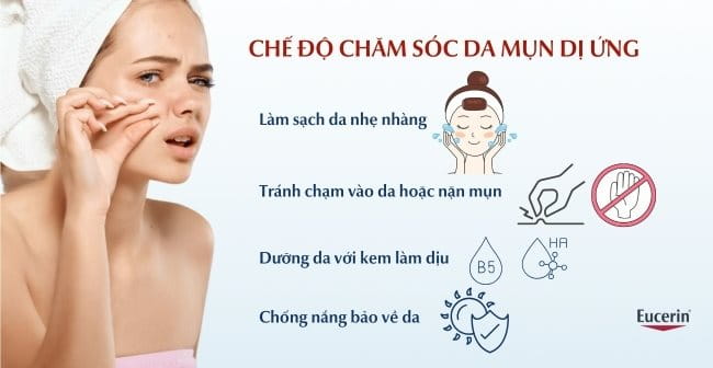 lưu ý khi chăm sóc da mụn dị ứng