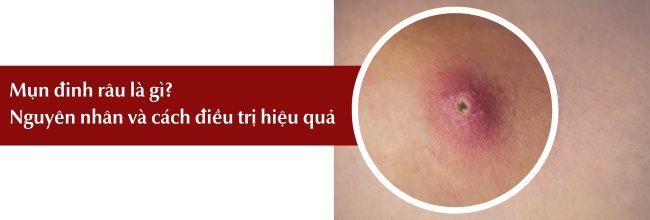 mụn đinh râu