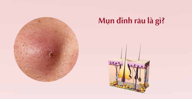 Mụn Đinh Râu: Nguyên Nhân, Triệu Chứng Và Cách Điều Trị Hiệu Quả