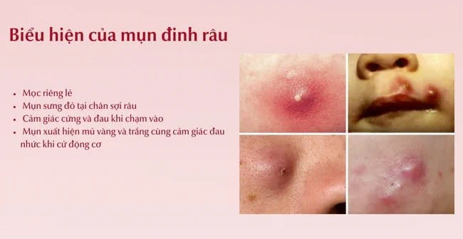 Mụn đinh râu là gì?