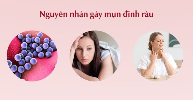 Nguyên nhân gây mụn đinh râu là gì?