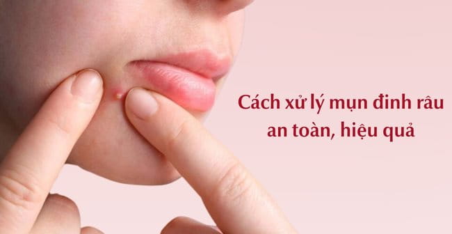 Cách xử lý mụn đinh râu an toàn, hiệu quả