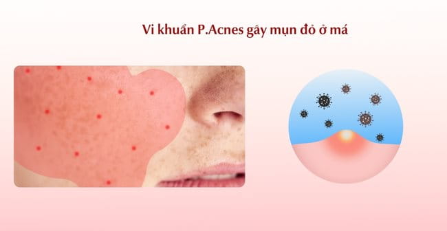 Vi khuẩn P.Acnes gây mụn đỏ ở má