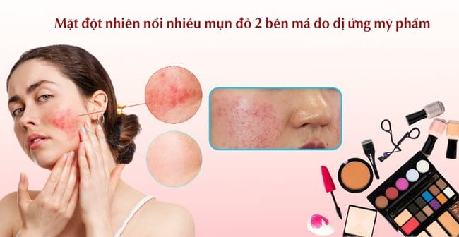 Mặt đột nhiên nổi nhiều mụn đỏ 2 bên má do dị ứng mỹ phẩm