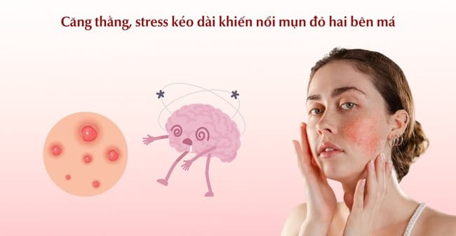 Căng thẳng kéo dài khiến nổi mụn đỏ ở má