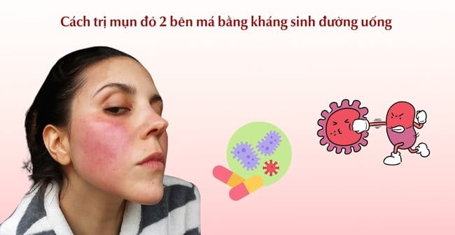 Cách trị mụn đỏ 2 bên má bằng kháng sinh đường uống 