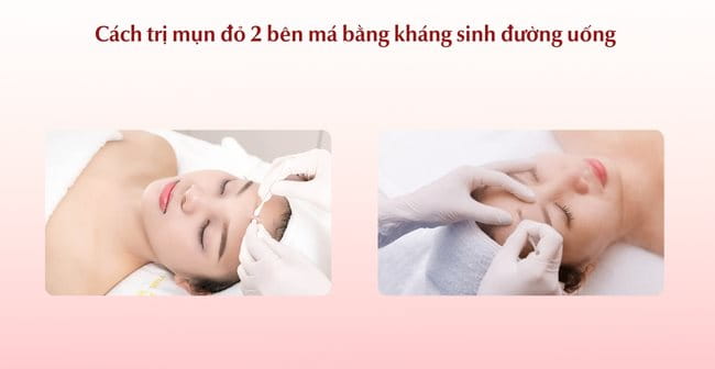 Lấy nhân mụn tại các cơ sở thẩm mỹ uy tín