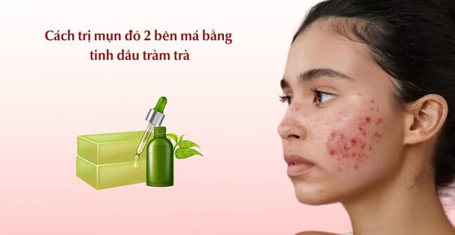 Trị mụn đỏ ở má tại nhà với tinh dầu tràm trà