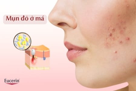 mụn đỏ ở má