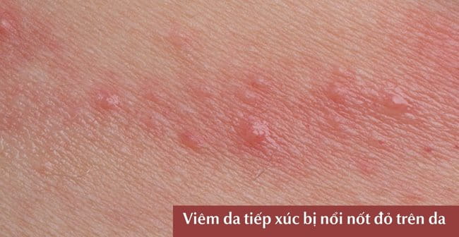 Viêm da tiếp xúc bị nổi nốt đỏ trên da