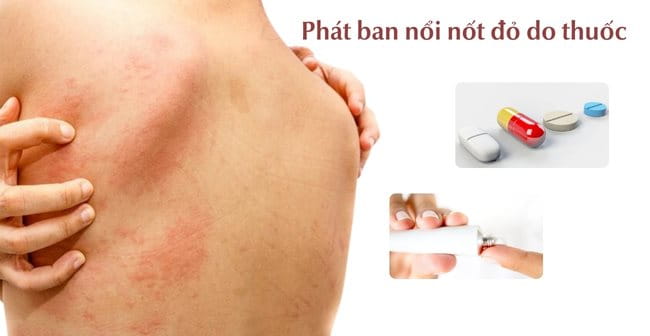 Phát ban do thuốc gây mụn đỏ trên da